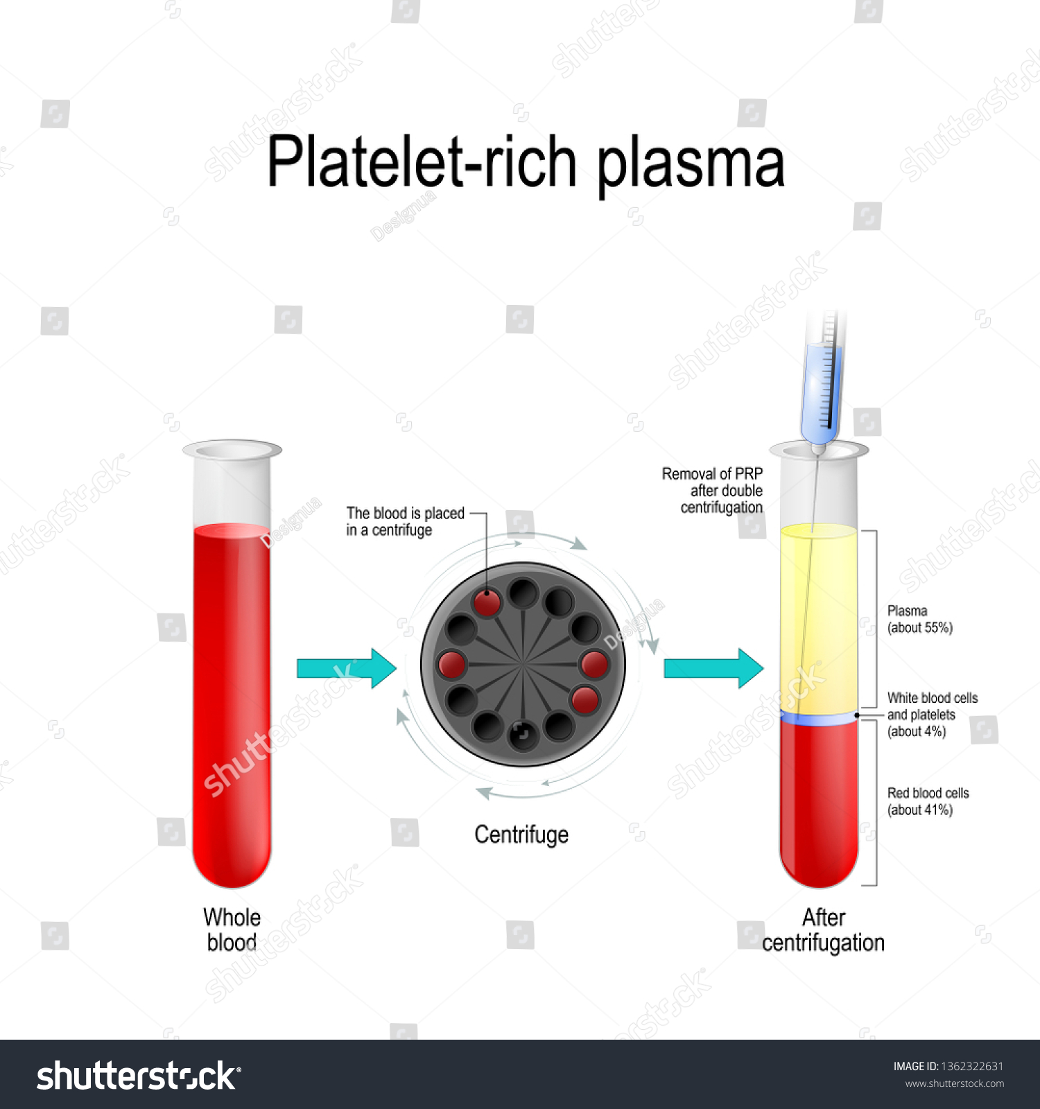 stock-photo-platelet-rich-plasma-autologous-conditioned-plasma-is-a ...