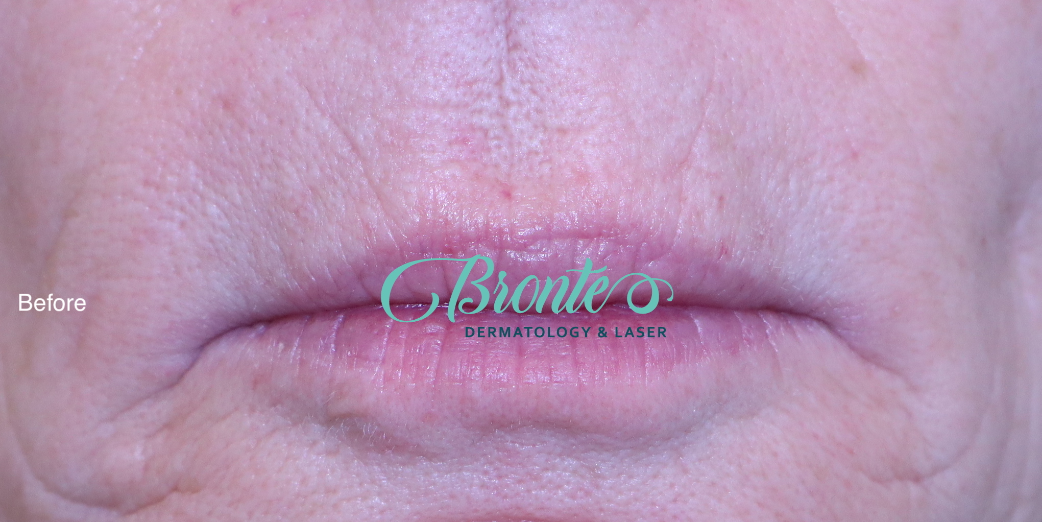 Before & 7 weeks after fractional Co2 laser treatment for personal wrinkle